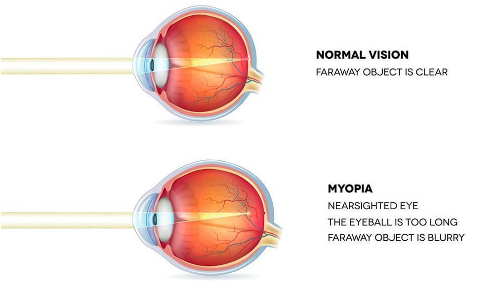 Chart Illustrating How Myopia Affects Light Coming Through an Eye